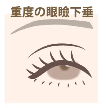 重度の眼瞼下垂 東京