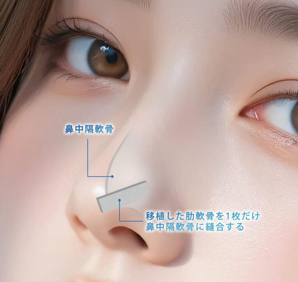 肋軟骨を1枚だけ移植して鼻先を高くした図解