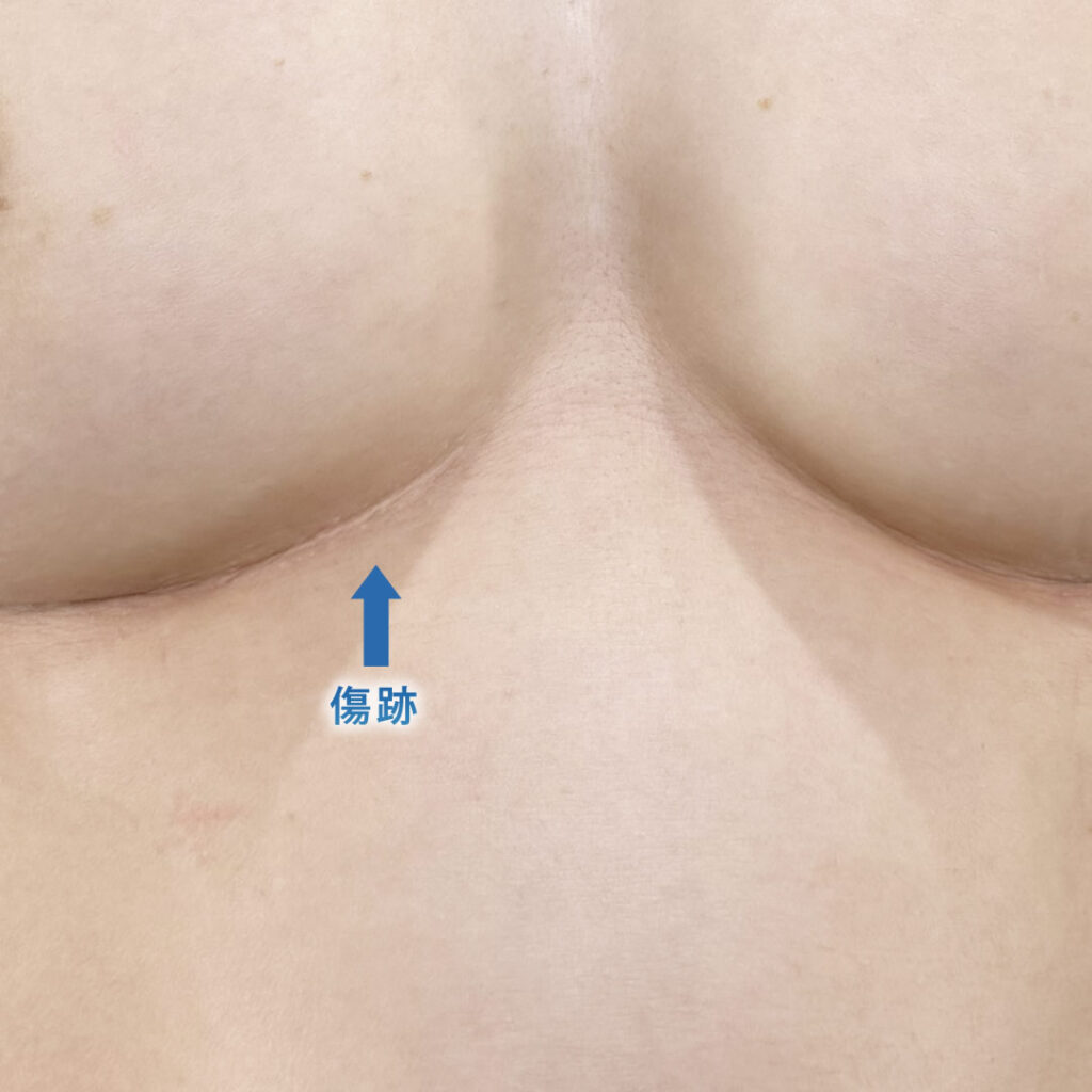 1年後後の肋軟骨の採取部分の傷跡