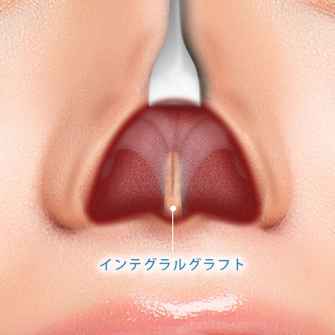 インテグラルグラフトを使った肋軟骨移植の鼻の中の解剖図