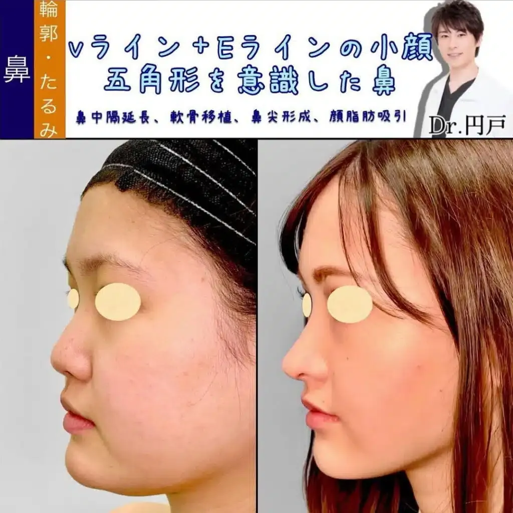 鼻中隔延長と軟骨移植と鼻尖形成と顔の脂肪吸引の症例写真
