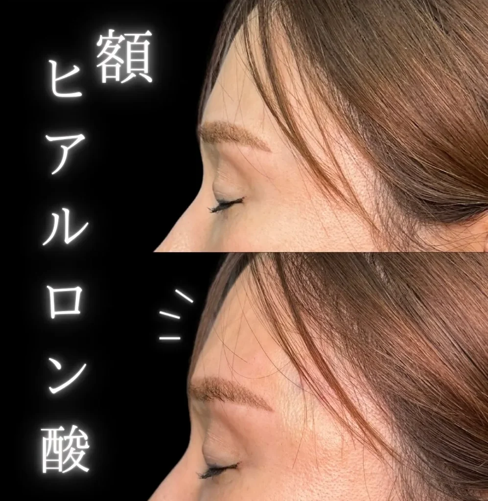 額ヒアル