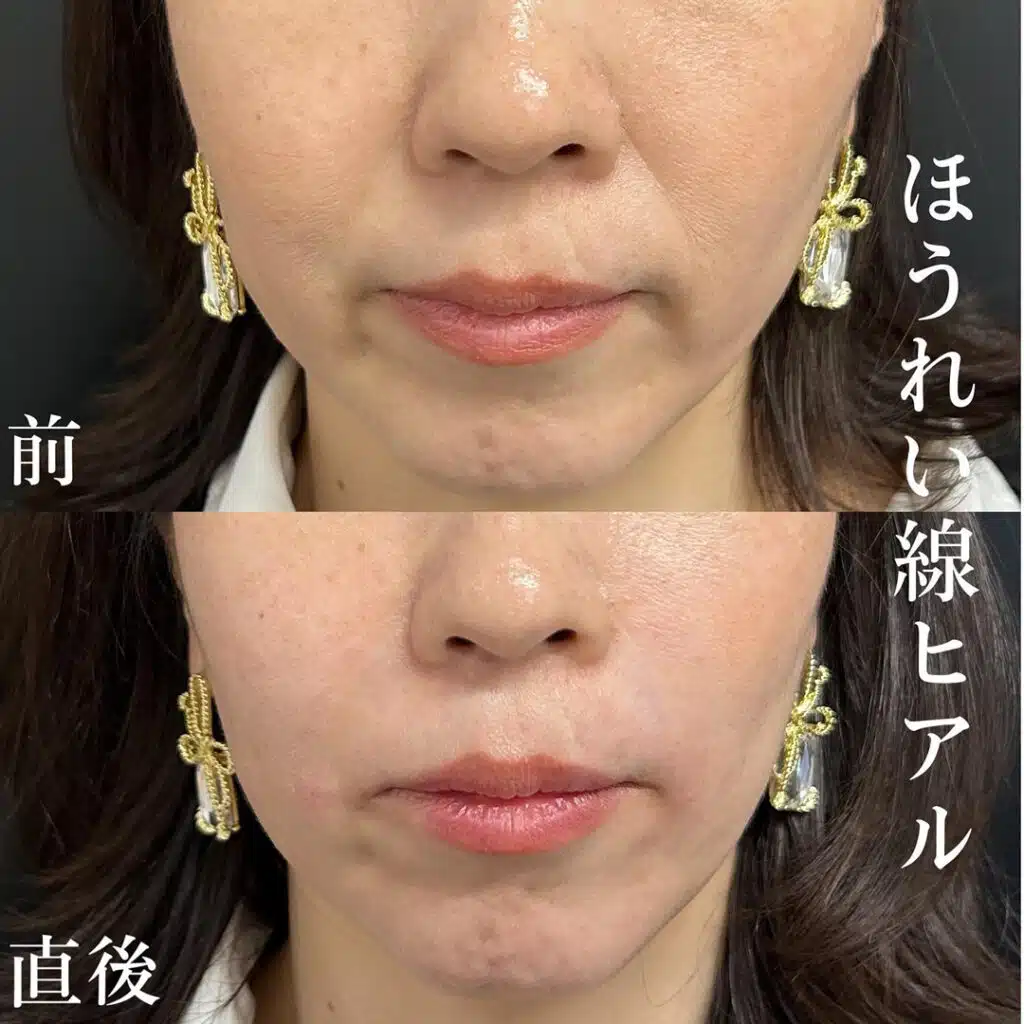 ほうれい線ヒアル
