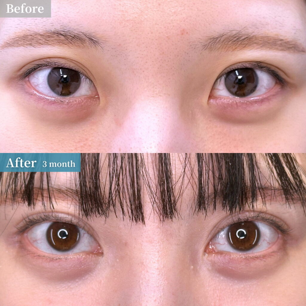 目頭切開の症例写真