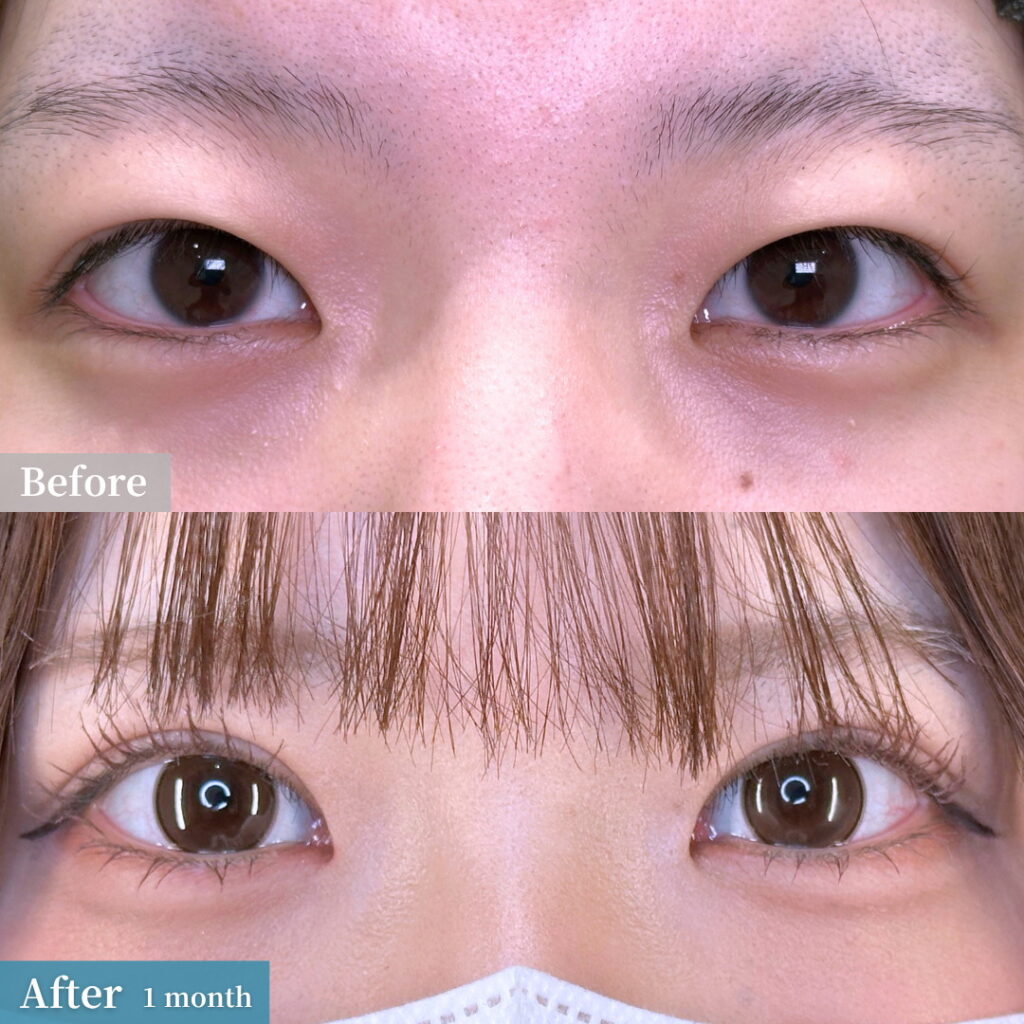 たるみ取り併用全切開の症例写真