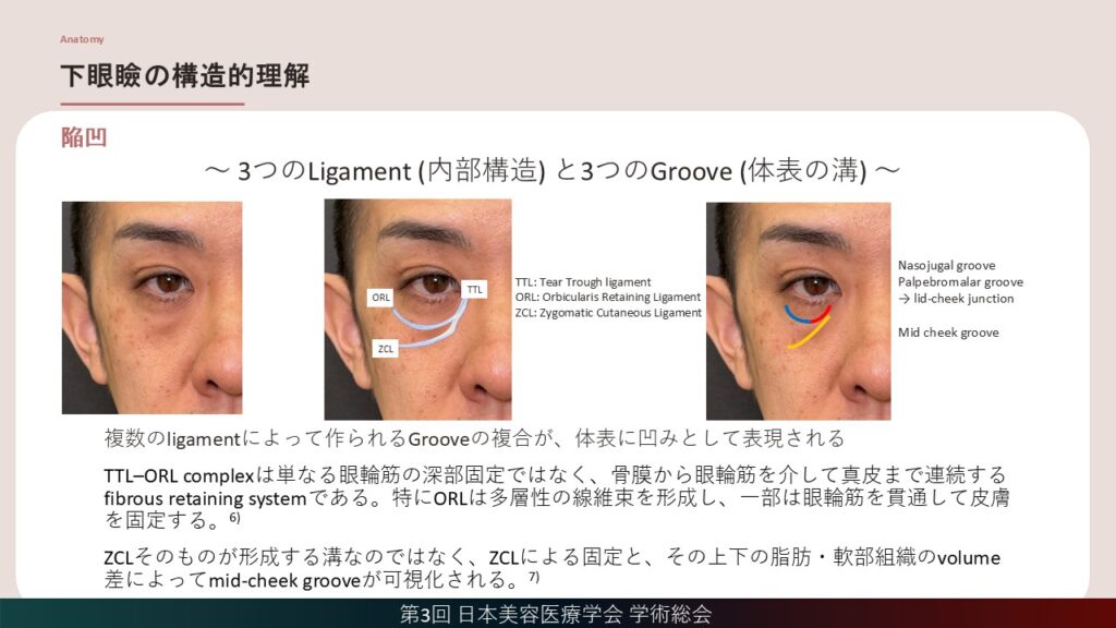 6_下眼瞼の構造的理解(陥凹)